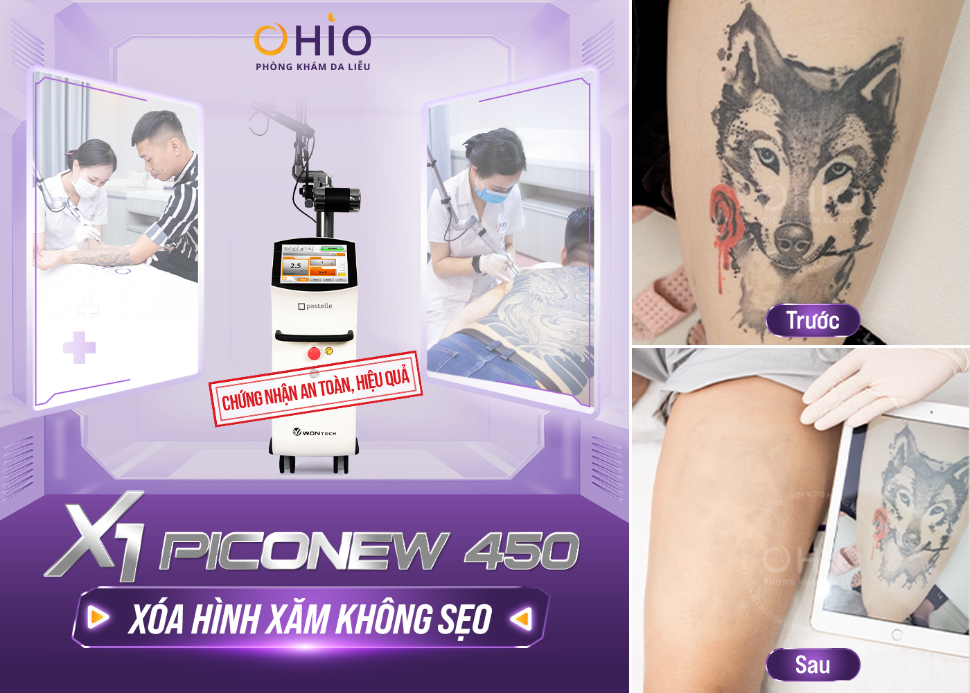 PICONEW 450 - XÓA HÌNH XĂM KHÔNG SẸO