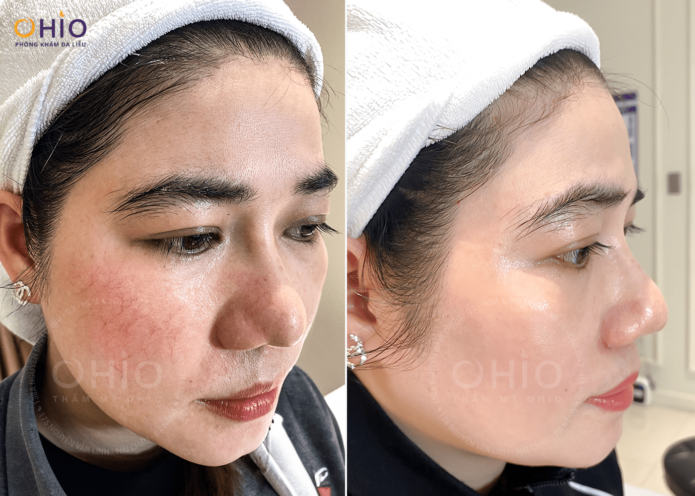 Giải phóng nhan sắc - Đón mừng Đại lễ - Ưu đãi 65% chi phí - Phòng khám da liễu OHIO Giải phóng nhan sắc - Đón mừng Đại lễ - Ưu đãi 65% chi phí