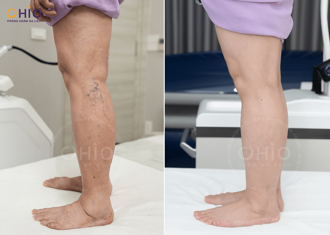 Giải phóng nhan sắc - Đón mừng Đại lễ - Ưu đãi 65% chi phí - Phòng khám da liễu OHIO Giải phóng nhan sắc - Đón mừng Đại lễ - Ưu đãi 65% chi phí