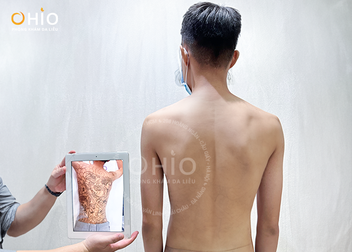Kết quả xóa xăm của khách hàng tại phòng khám OHIO