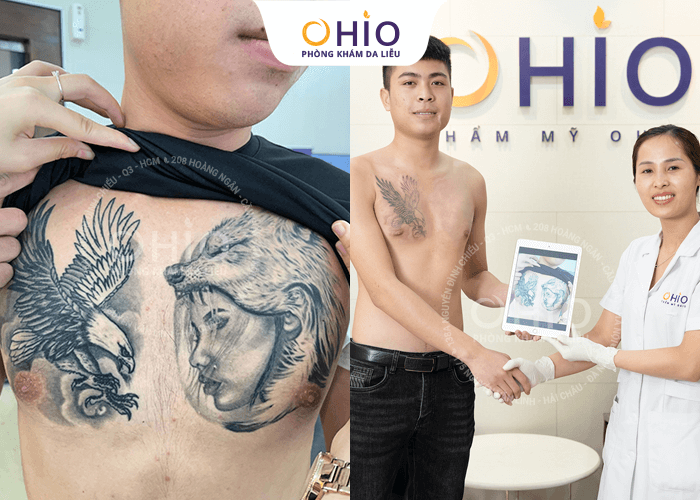 Địa chỉ xóa xăm uy tín tại Sài Gòn