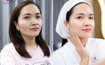 Tạm biệt gương mặt đỏ rực vì giãn mao mạch – Chị Hoài Thơm và hành trình hồi phục da tại OHIO - Phòng khám da liễu OHIO Tạm biệt gương mặt đỏ rực vì giãn mao mạch – Chị Hoài Thơm và hành trình hồi phục da tại OHIO