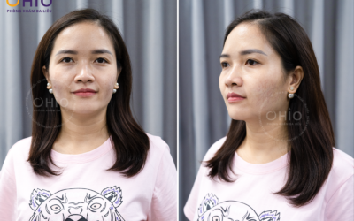 Tạm biệt gương mặt đỏ rực vì giãn mao mạch – Chị Hoài Thơm và hành trình hồi phục da tại OHIO - Phòng khám da liễu OHIO mao mạch