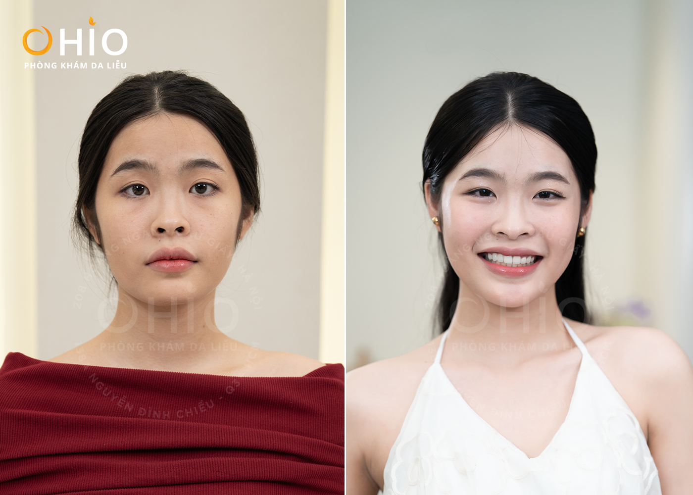 Điều trị da liễu tại Vinh với Thạc sĩ, Bác sĩ Nguyễn Thị Thanh Hòa - Phòng khám da liễu OHIO Khách hàng làm dịch vụ trẻ hóa tại OHIO chi nhánh Vinh
