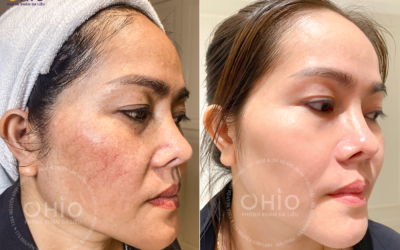 Bác sĩ da liễu Đà Nẵng giỏi 20 năm kinh nghiệm khám chữa bệnh da liễu - Phòng khám da liễu OHIO Bác sĩ da liễu Đà Nẵng giỏi 20 năm kinh nghiệm khám chữa bệnh da liễu