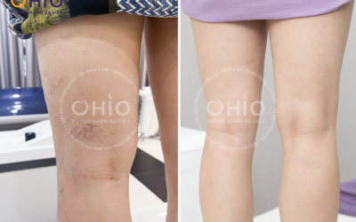 Trị giãn mao mạch chân phòng ngừa giãn tĩnh mạch (Chị Ái Liên - 54 tuổi) - Phòng khám da liễu OHIO Trị giãn mao mạch chân phòng ngừa giãn tĩnh mạch (Chị Ái Liên - 54 tuổi)