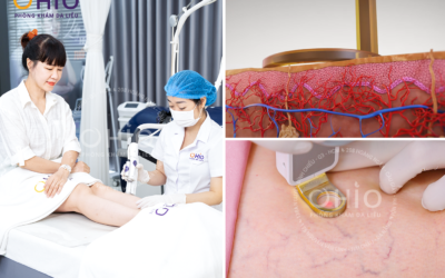 Trị giãn mao mạch chân phòng ngừa giãn tĩnh mạch (Chị Ái Liên - 54 tuổi) - Phòng khám da liễu OHIO giãn mao mạch chân
