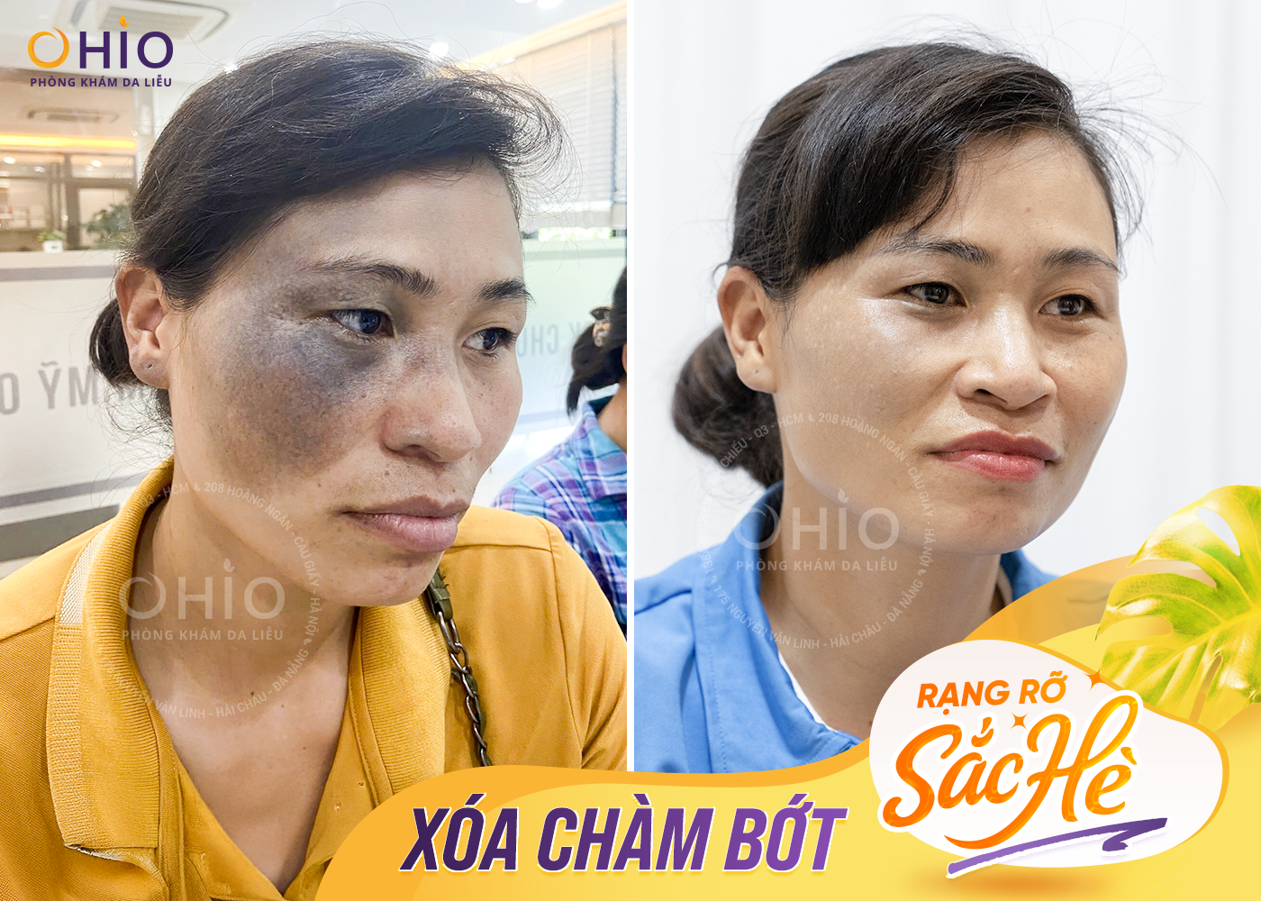 Điều trị chàm bớt tại OHIO