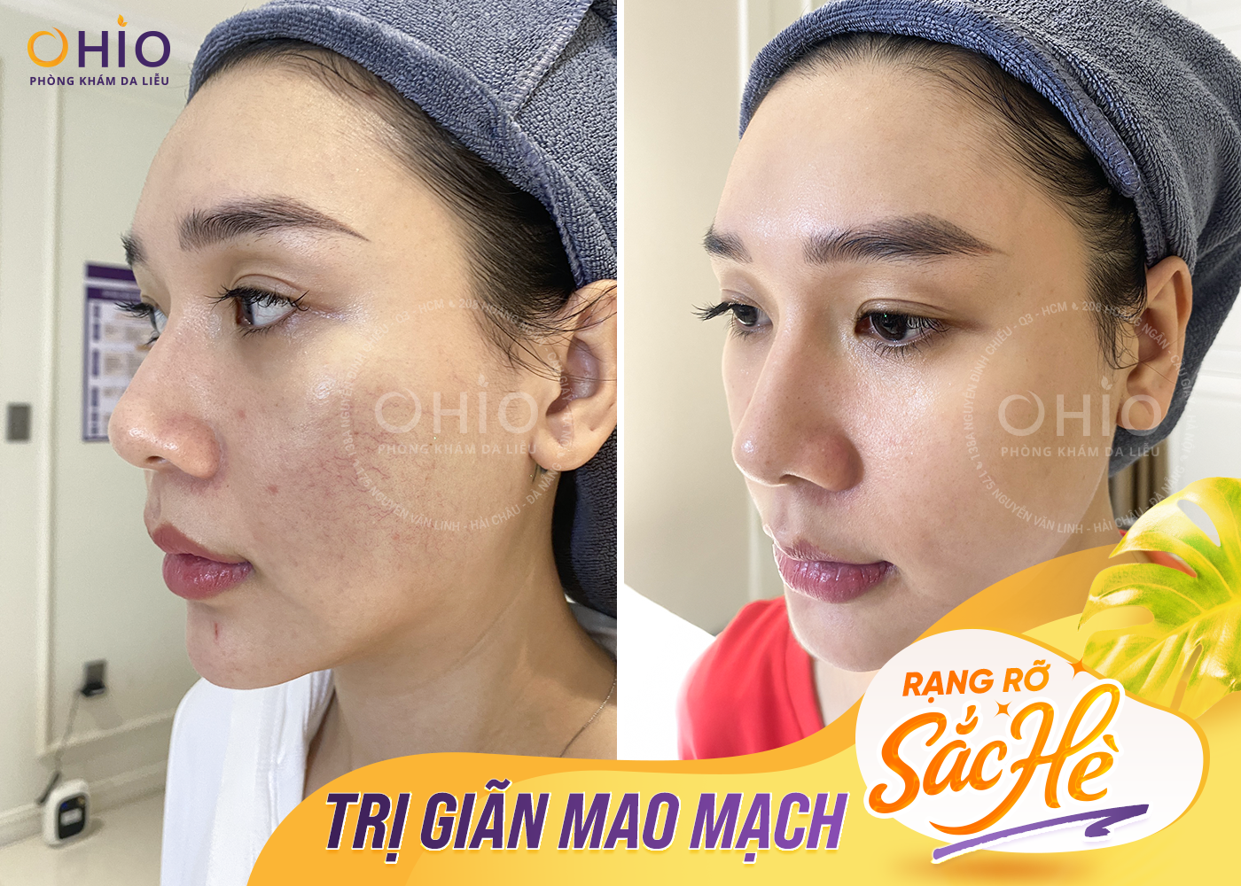 Điều trị giãn mao mạch tại OHIO
