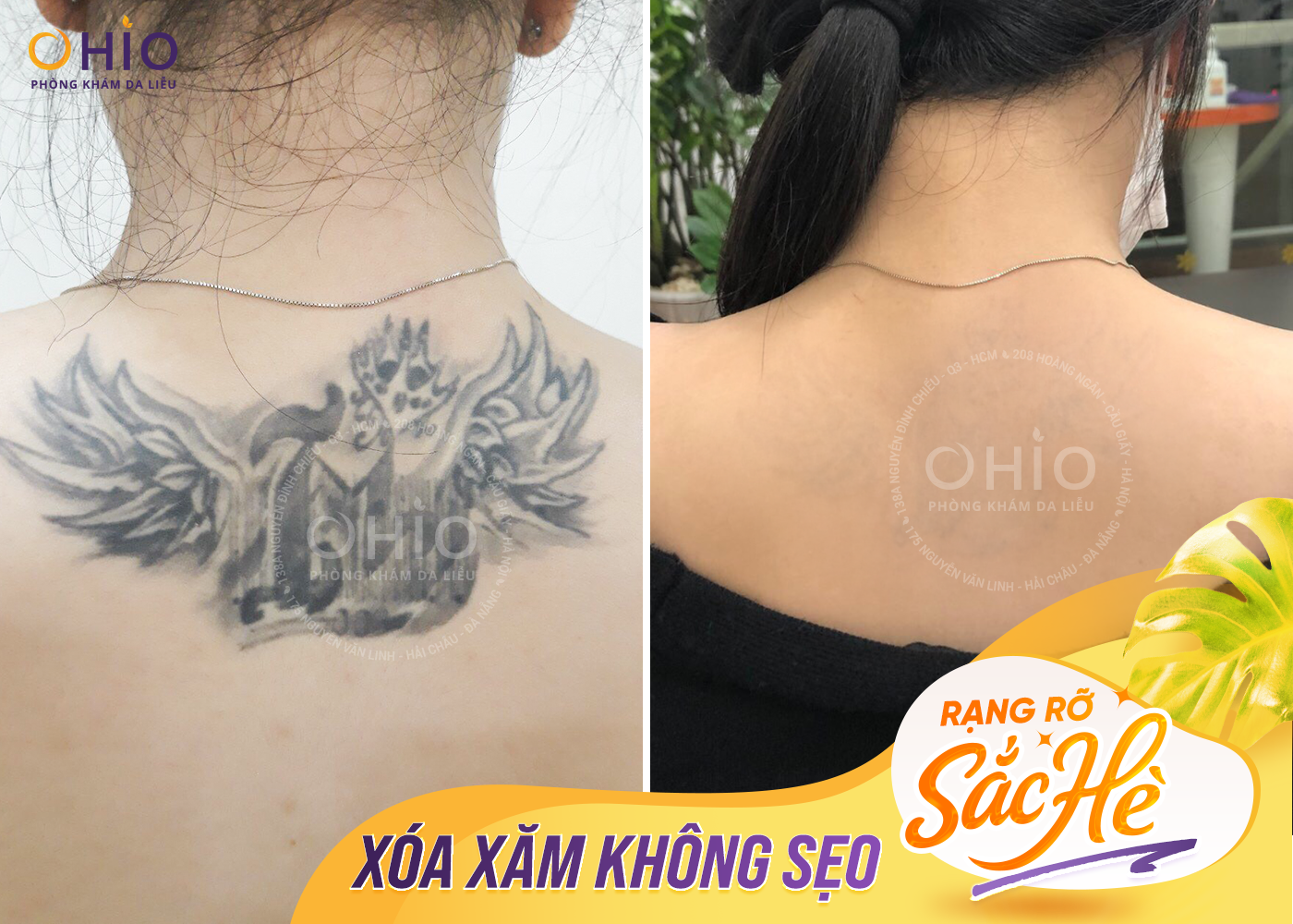 Xóa xăm không sẹo tại OHIO 