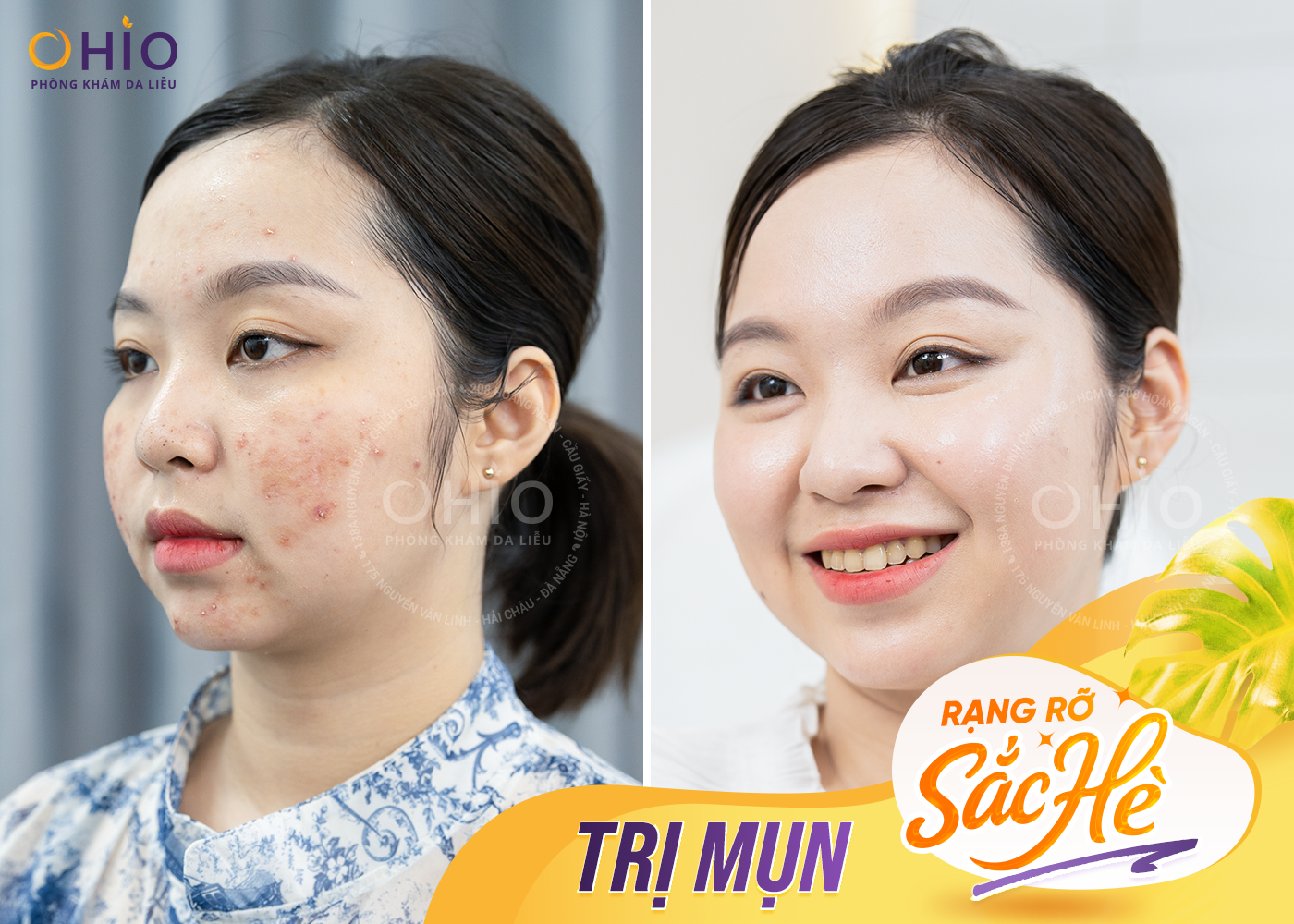 Trị mụn tại phòng khám OHIO