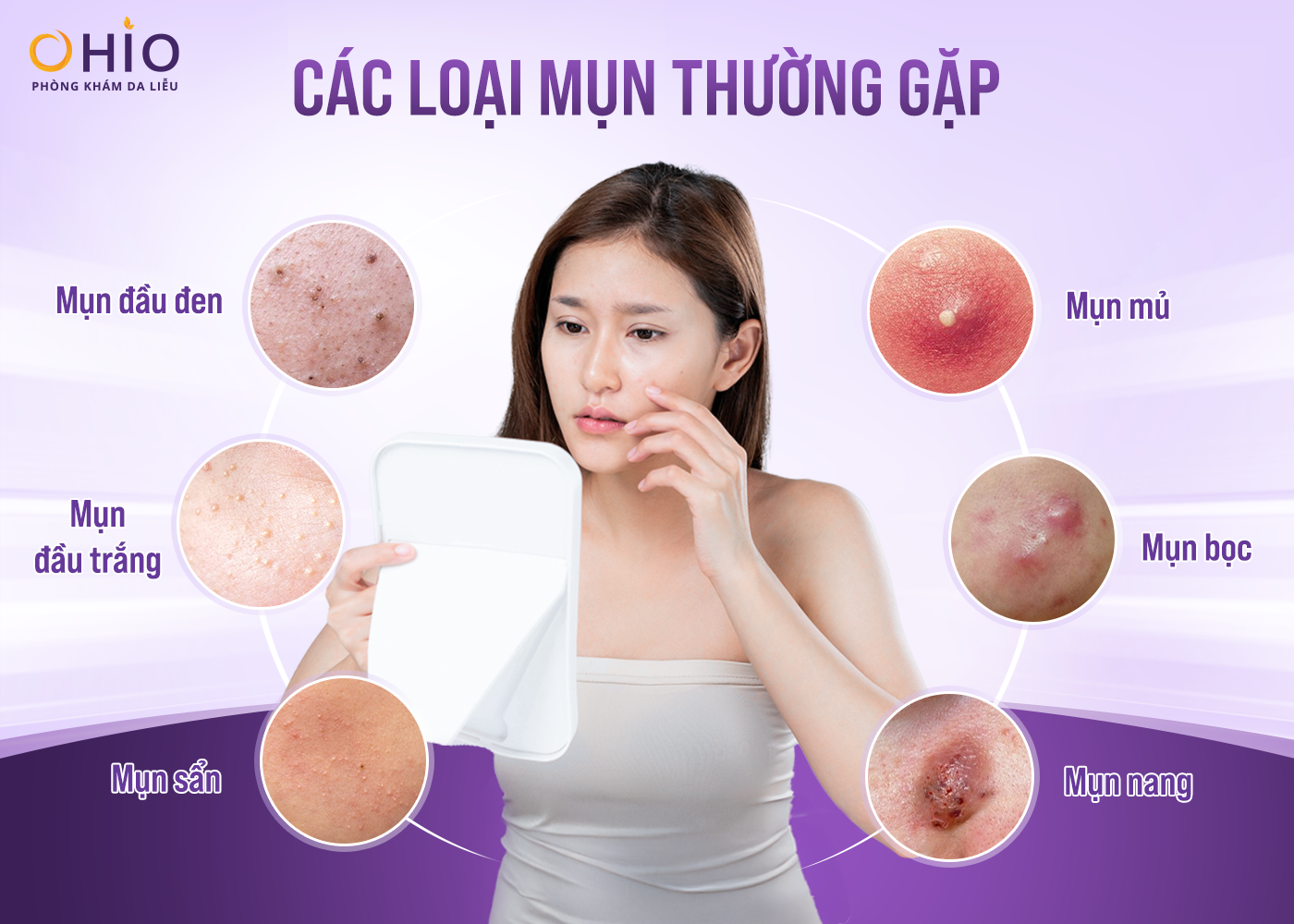 Các Loại Mụn Phổ Biến & Giải Pháp Trị Mụn Chuẩn Y Khoa Tại Phòng Khám Da Liễu OHIO - Phòng khám da liễu OHIO trị mụn