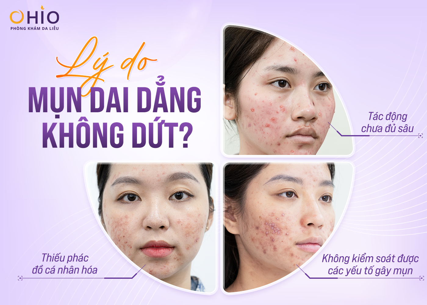 Các Loại Mụn Phổ Biến & Giải Pháp Trị Mụn Chuẩn Y Khoa Tại Phòng Khám Da Liễu OHIO - Phòng khám da liễu OHIO trị mụn mãi không hết
