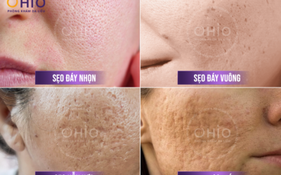 Trị Sẹo Rỗ Hiệu Quả Tại Đà Nẵng: Phòng Khám Da Liễu OHIO - Địa Chỉ Uy Tín Được Sở Y Tế Cấp Phép - Phòng khám da liễu OHIO trị sẹo rỗ