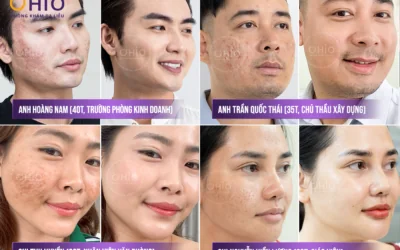 Trị Sẹo Rỗ Hiệu Quả Tại Đà Nẵng: Phòng Khám Da Liễu OHIO - Địa Chỉ Uy Tín Được Sở Y Tế Cấp Phép - Phòng khám da liễu OHIO trị sẹo rỗ hiệu quả