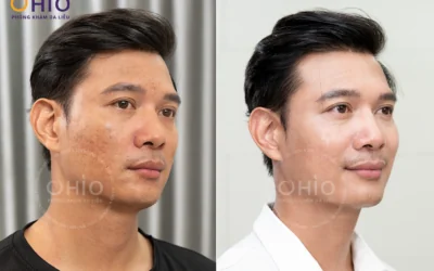 Trị Sẹo Rỗ Hiệu Quả Tại Đà Nẵng: Phòng Khám Da Liễu OHIO - Địa Chỉ Uy Tín Được Sở Y Tế Cấp Phép - Phòng khám da liễu OHIO Trị Sẹo Rỗ Hiệu Quả Tại Đà Nẵng: Phòng Khám Da Liễu OHIO - Địa Chỉ Uy Tín Được Sở Y Tế Cấp Phép