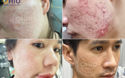  Tổ Hợp Công Nghệ PULSE SCAR công nghị trị sẹo rỗ
