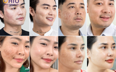 công nghệ trị sẹo rỗ