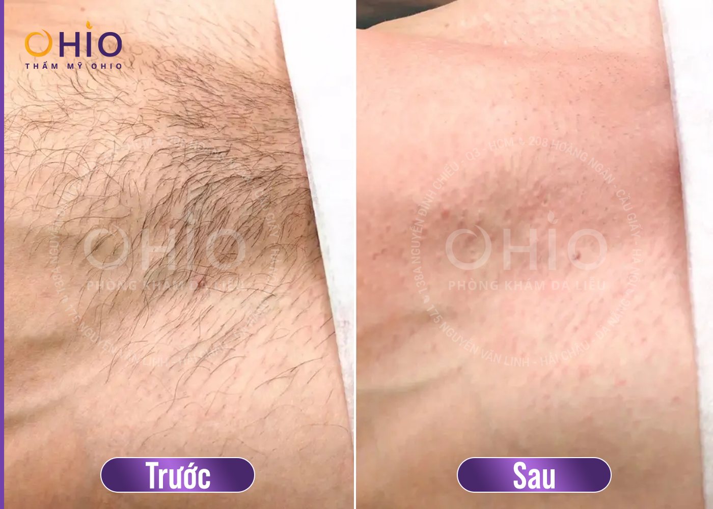 Nam Giới có nên Triệt lông vùng kín? - Phòng khám da liễu OHIO Nam Giới có nên Triệt lông vùng kín?