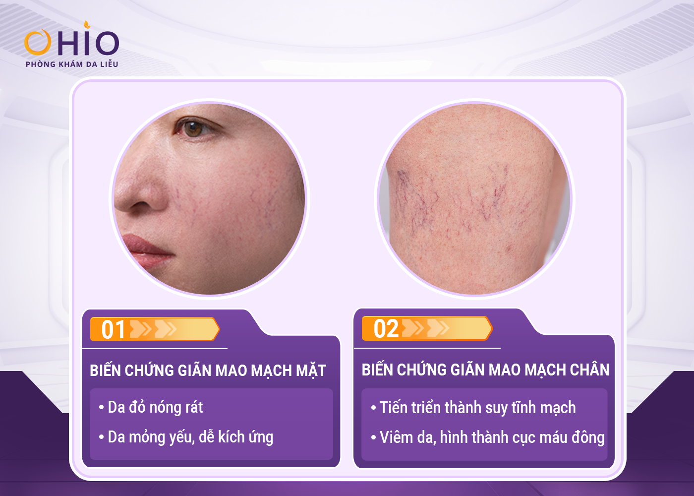 Trị giãn mao mạch ở đâu uy tín? - Phòng khám da liễu OHIO điều trị giãn mao mạch ở đâu