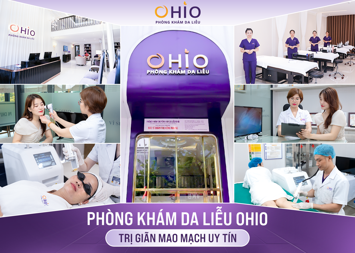 Trị giãn mao mạch ở đâu uy tín? - Phòng khám da liễu OHIO Trị giãn mao mạch ở đâu uy tín?