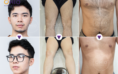 Thẩm mỹ chuyên sâu Triệt lông cho Nam giới uy tín - Phòng khám da liễu OHIO Thẩm mỹ chuyên sâu Triệt lông cho Nam giới uy tín