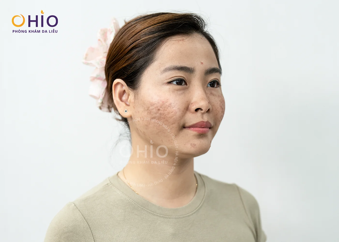 Hành Trình Lấy Lại Sự Tự Tin Của Chị Thu Huyền Chỉ Sau Một Liệu Trình Trị Sẹo Tại OHIO - Phòng khám da liễu OHIO Tình trạng sẹo của chị Thu Huyền