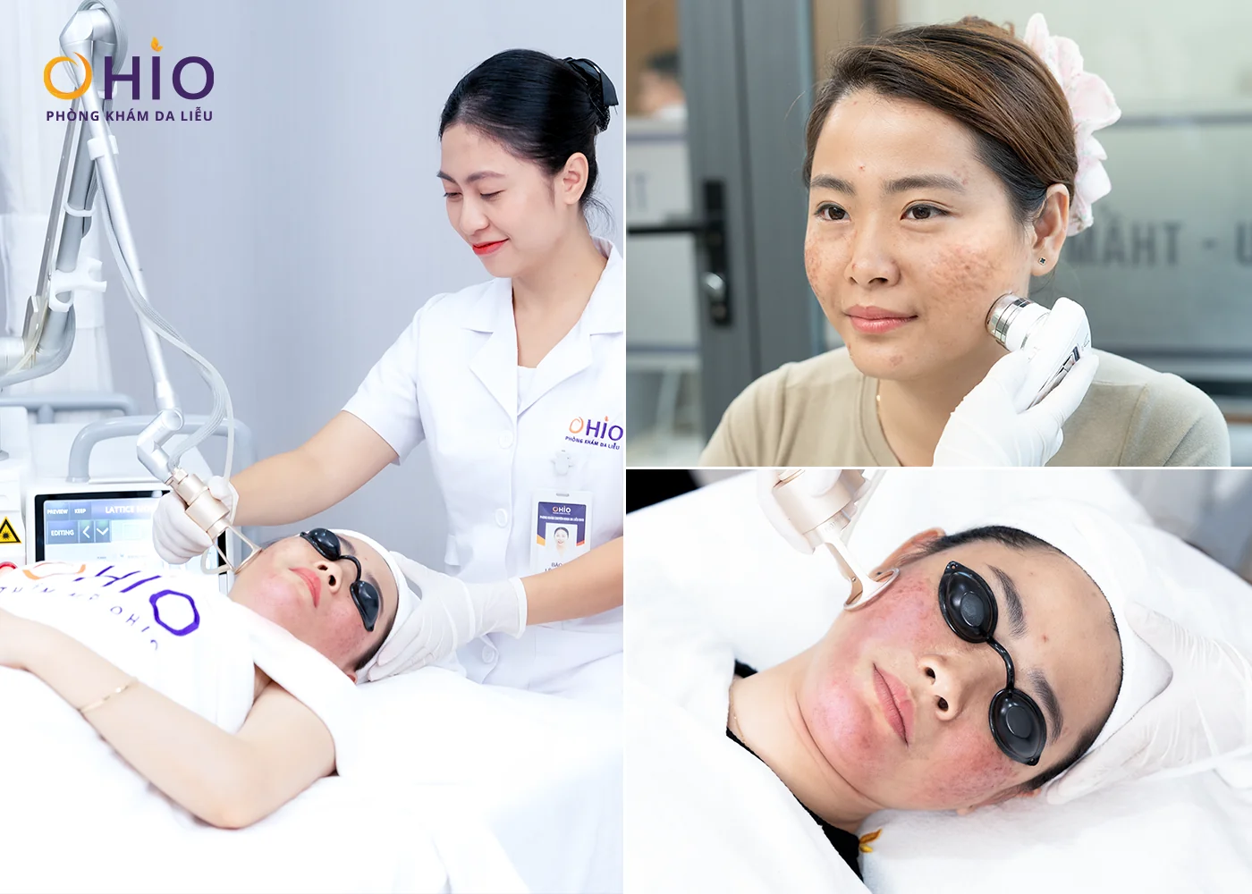 Hành Trình Lấy Lại Sự Tự Tin Của Chị Thu Huyền Chỉ Sau Một Liệu Trình Trị Sẹo Tại OHIO - Phòng khám da liễu OHIO công nghệ trị sẹo Pulse Scar
