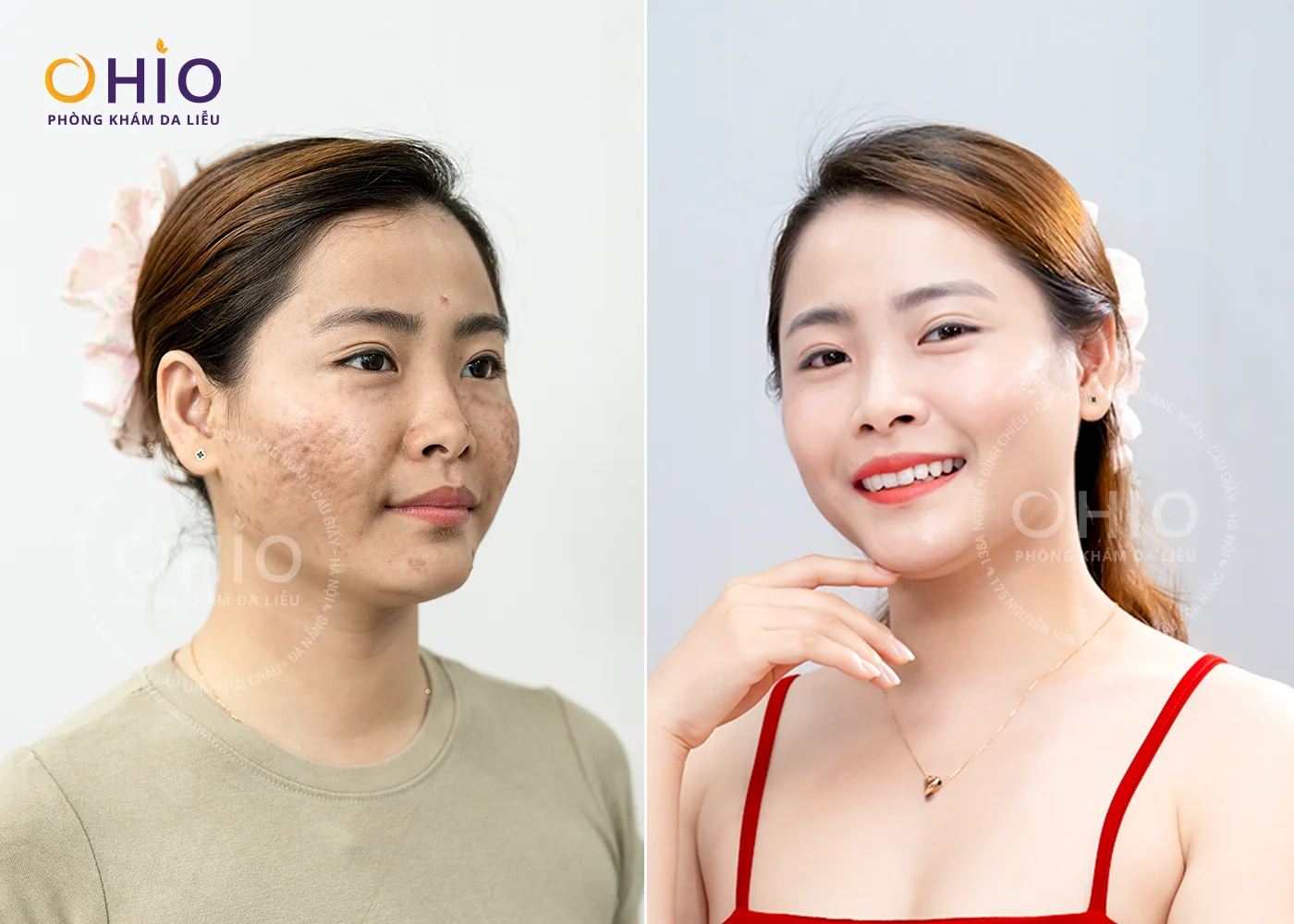 Hành Trình Lấy Lại Sự Tự Tin Của Chị Thu Huyền Chỉ Sau Một Liệu Trình Trị Sẹo Tại OHIO - Phòng khám da liễu OHIO Kết quả điều trị sẹo rỗ của chị Thu Huyền