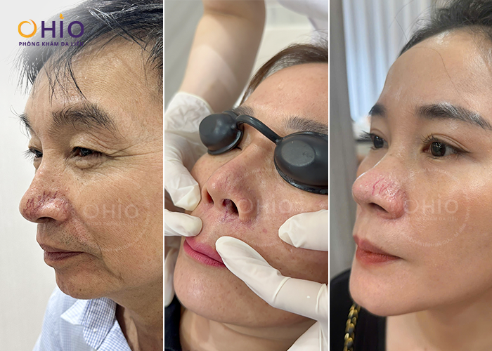 Giãn mao mạch vùng mũi gây mất thẩm mỹ Giãn mao mạch mũi, Nguyên nhân và cách điều trị hiệu quả cao