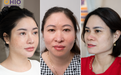 Giãn mao mạch mặt, nguyên nhân và cách điều trị