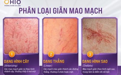 Giãn mao mạch mặt, nguyên nhân và cách điều trị