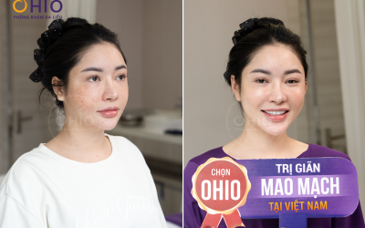 Giãn mao mạch mặt, nguyên nhân và cách điều trị