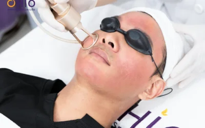 Trị Sẹo Rỗ Có Đau Không? Trải Nghiệm Tổ Hợp Công Nghệ Pulse Scar Tại OHIO - Phòng khám da liễu OHIO phương pháp trị sẹo rỗ không đau