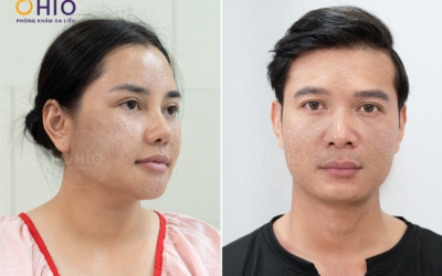 trị sẹo rỗ có đau không
