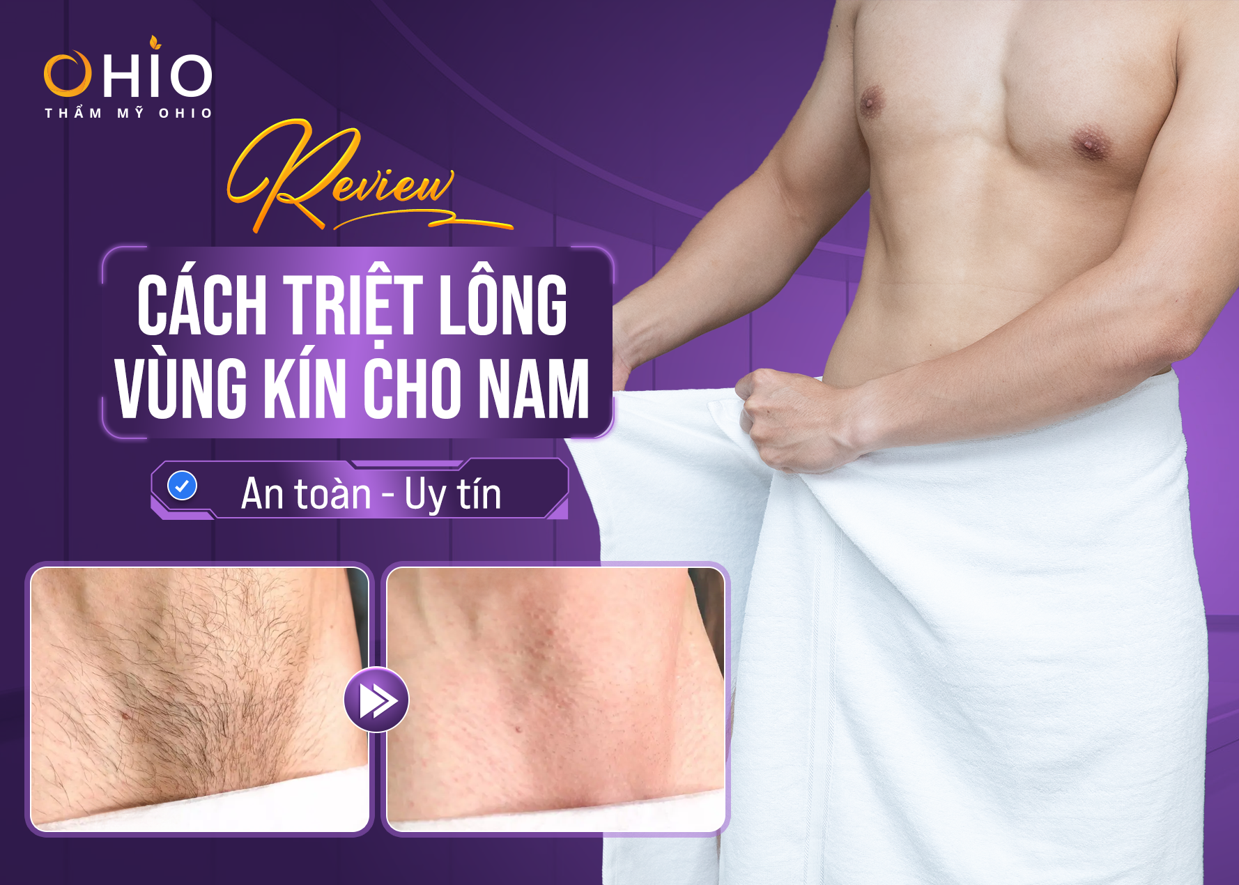 triệt lông vùng kín triệt lông vùng kín
