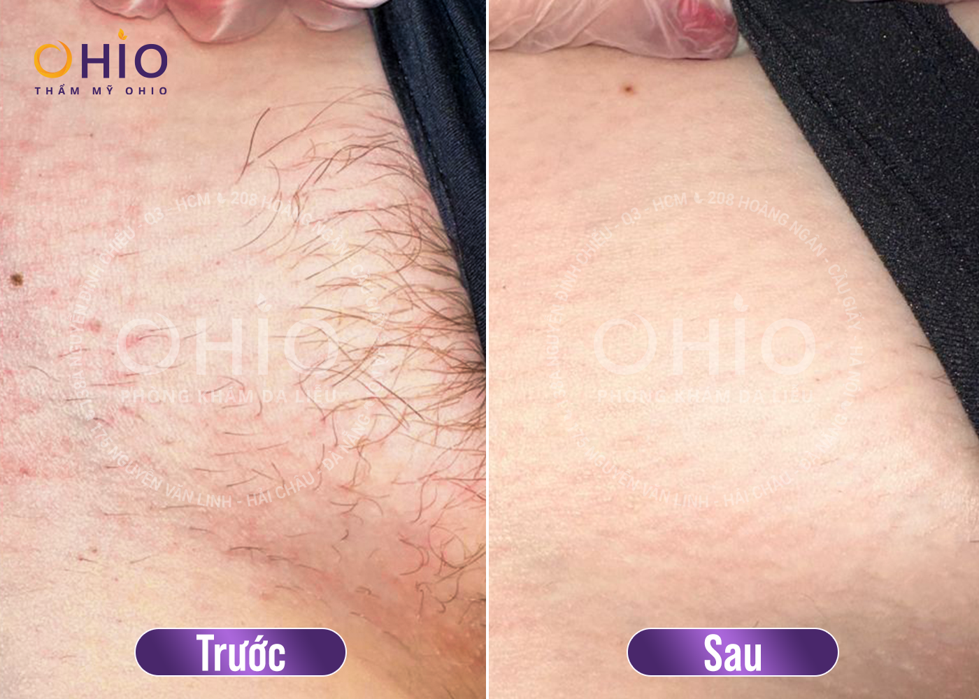 Review cách triệt lông vùng kín cho nam an toàn, uy tín? - Phòng khám da liễu OHIO Review cách triệt lông vùng kín cho nam an toàn, uy tín?