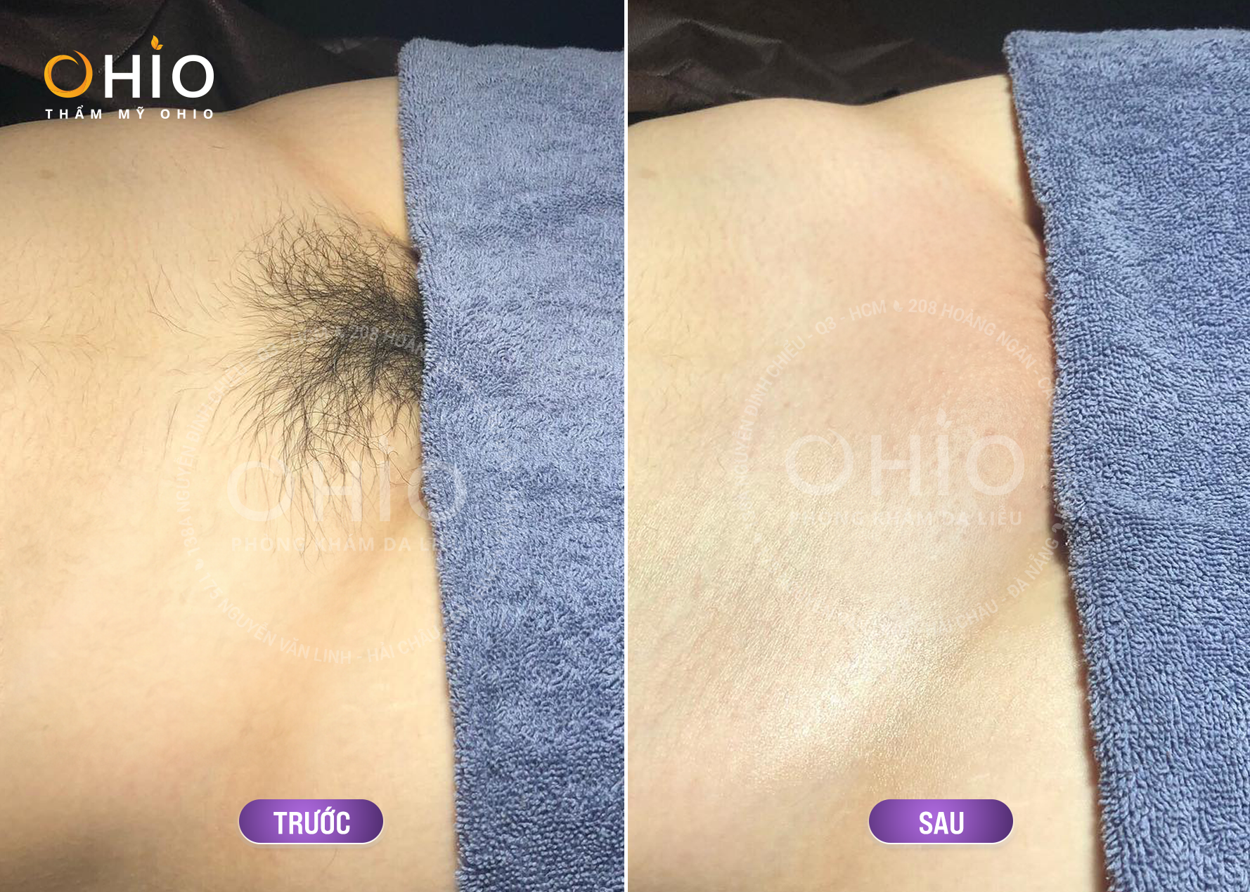 Địa chỉ triệt lông vùng kín tại Hà Nội đẳng cấp Quý Ông - Phòng khám da liễu OHIO Địa chỉ triệt lông vùng kín tại Hà Nội đẳng cấp Quý Ông