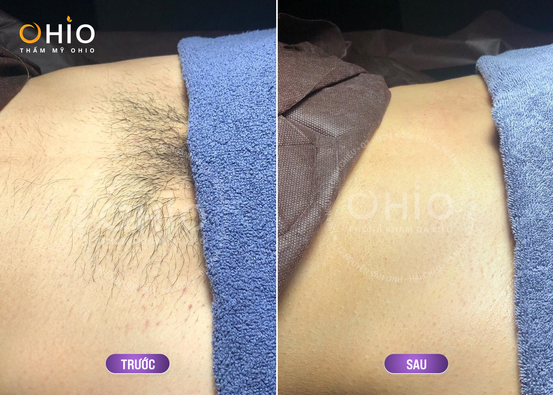 Địa chỉ triệt lông vùng kín tại Hà Nội đẳng cấp Quý Ông - Phòng khám da liễu OHIO Địa chỉ triệt lông vùng kín tại Hà Nội đẳng cấp Quý Ông