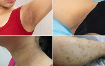Thâm sạm – Nỗi lo âm thầm, phụ nữ hiện đại không nên xem nhẹ - Phòng khám da liễu OHIO thâm da