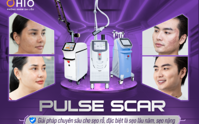 PULSE SCAR Tại Phòng Khám Da Liễu OHIO: Công Nghệ Tiên Phong Trị Sẹo Nhanh Phục Hồi, Hiệu Quả Cao, Không Phải Nghỉ Dưỡng - Phòng khám da liễu OHIO PULSE SCAR Tại Phòng Khám Da Liễu OHIO: Công Nghệ Tiên Phong Trị Sẹo Nhanh Phục Hồi, Hiệu Quả Cao, Không Phải Nghỉ Dưỡng