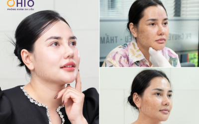 tiên phong trị sẹo nhanh phục hồi