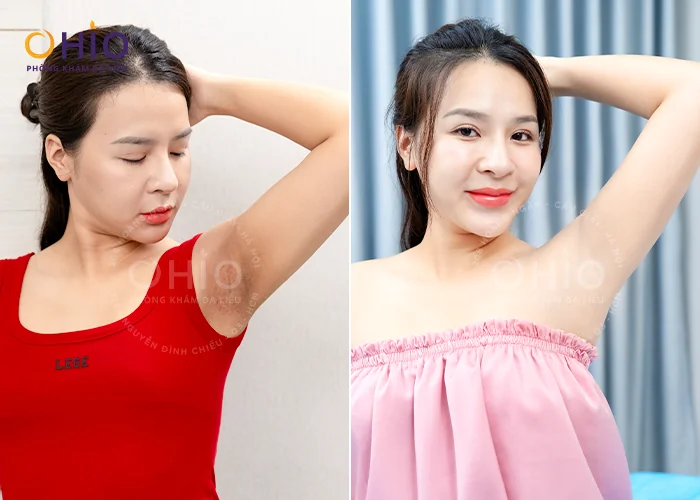 Thâm nách – Nỗi ám ảnh của phái đẹp trong mùa hè - Phòng khám da liễu OHIO Thâm nách – Nỗi ám ảnh của phái đẹp trong mùa hè