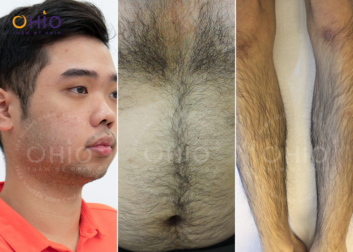 Bảng giá Triệt lông cho Nam giới cập nhật - Phòng khám da liễu OHIO Bảng giá Triệt lông cho Nam giới cập nhật