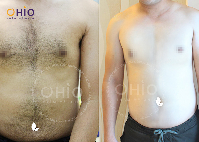 Bảng giá Triệt lông cho Nam giới cập nhật - Phòng khám da liễu OHIO Bảng giá Triệt lông cho Nam giới cập nhật