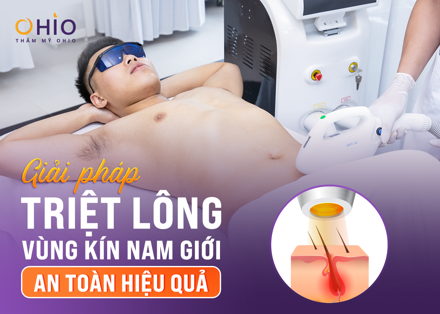 triệt lông vùng kín