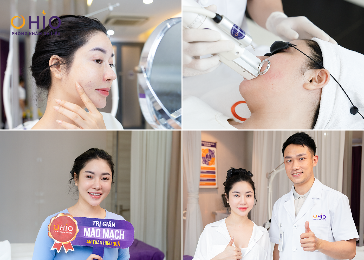 Giãn mao mạch điều trị dứt điểm với tổ hợp Công nghệ laser xung dài - Phòng khám da liễu OHIO Giãn mao mạch điều trị dứt điểm với tổ hợp Công nghệ laser xung dài