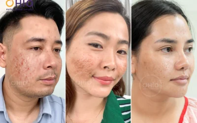 TRỊ SẸO RỖ KHÔNG CẦN PHẪU THUẬT BẰNG CÔNG NGHỆ PULSE SCAR - Phòng khám da liễu OHIO trị sẹo rỗ