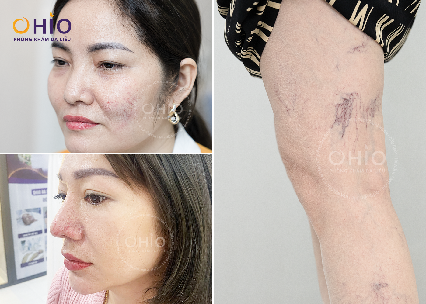 Giãn mao mạch điều trị dứt điểm với tổ hợp Công nghệ laser xung dài - Phòng khám da liễu OHIO Giãn mao mạch điều trị dứt điểm với tổ hợp Công nghệ laser xung dài