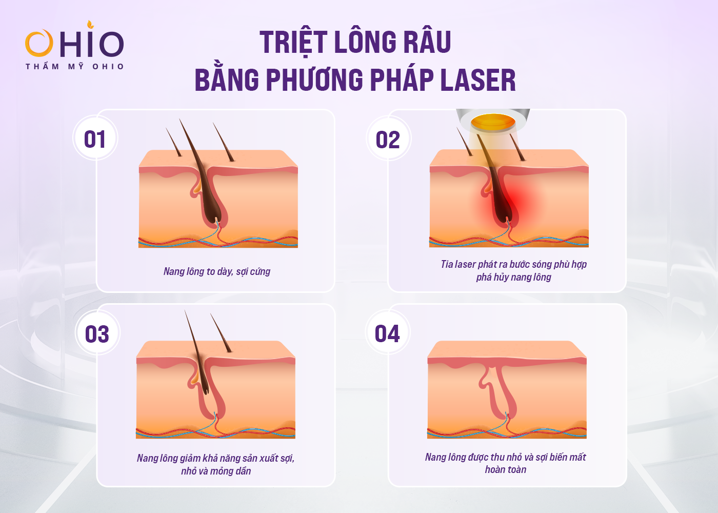 Triệt râu, Triệt lông cho Nam có thực sự hiệu quả? - Phòng khám da liễu OHIO Triệt râu cho phái mạnh